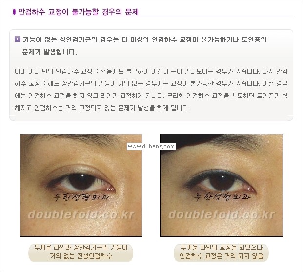 [두한성형외과 경쟁력 쌍꺼풀 재수술, 극한 재수술] - [쌍꺼풀 재수술, 극한 재수술 시 문제점 안내] 관련 이미지 8