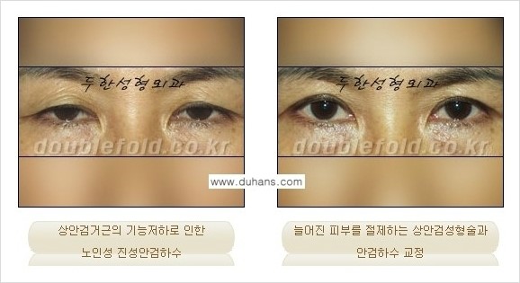 ⁠⁠[두한성형외과 경﻿쟁력 쌍꺼풀 재수술] - [안검하수(졸리운 눈매) 종류와 교정 방법 안내] 관련 이미지 8