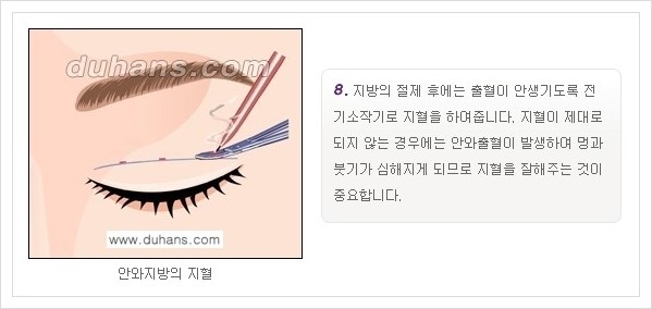 [두한성형외과 경쟁력 눈성형, 쌍꺼풀 수술] - [퀵쌍꺼풀(부분절개법)의 수술 안내] 관련 이미지 9