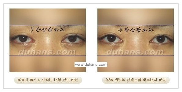 [두한성형외과 경쟁력 쌍꺼풀 재수술, 극한 재수술] - [비대칭(짝짝이) 쌍꺼풀 라인 교정 안내] 관련 이미지 3