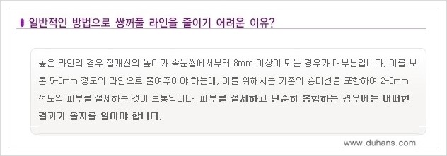 [두한성형외과 경쟁력 쌍꺼풀 재수술] - [두껍고 어색한 라인 교정하는 방법 안내 1.] 관련 이미지 7