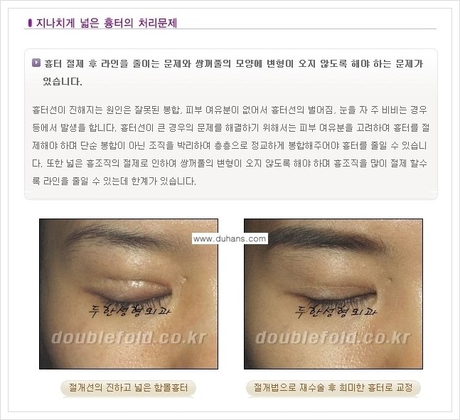 [두한성형외과 경쟁력 쌍꺼풀 재수술(극한 재수술)] - [쌍꺼풀 재수술에서 극복해야 할 여러 가지 상황과 문제점들 안내] 관련 이미지 2