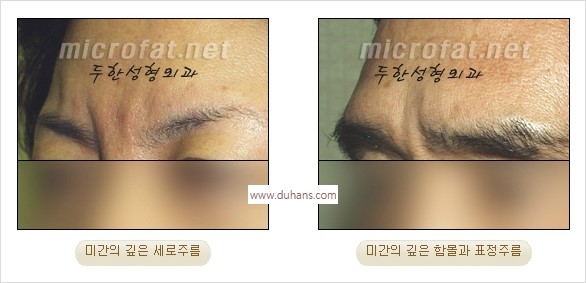 [두한성형외과 경쟁력 동안성형 리더] - ​[미간주름, 이마주름, 안검성형, 이마거상술, 눈썹거상술] 관련 이미지 1