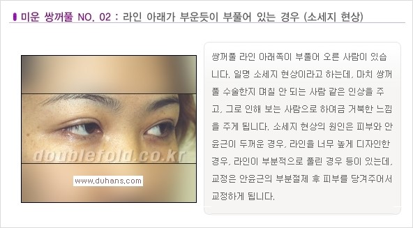 [두한성형외과 경쟁력 쌍꺼풀 재수술, 극한 재수술] - [일반적인 기준의 미운 쌍꺼풀과 아름다운 쌍꺼풀 안내] 관련 이미지 2