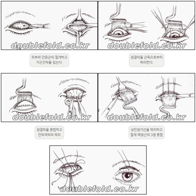 [Ptosis, Duhan Plastic Surgery] - [Sleepy-Looking Eyes, Ptosis Eye Correction] image 11