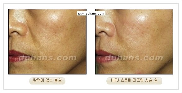 [두한성형외과 경쟁력 주름성형] - [HIFU 초음파 리프팅 주름교정술 안내 2.] 관련 이미지 21