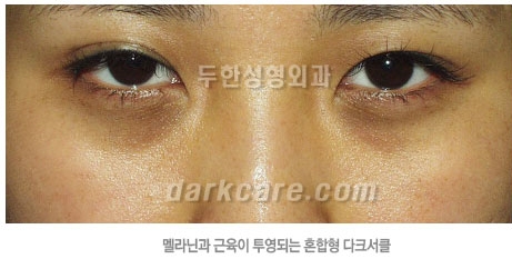 Duhan Plastic Surgery Dark Circle Improvement - What Causes Dark Circles? What Types of Dark Circles Are There? image 21