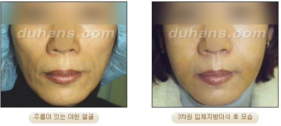 [두한성형외과 얼굴자가지방이식] - [볼살, 이마, 측두부] 관련 이미지 10