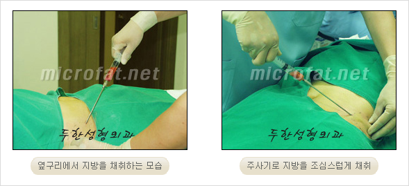 [두한성형외과 경쟁력 안면윤곽 성형 리더] - [완변한 V 라인! 턱 미세지방이식, 볼살 미세지방이식, 사각턱 보톡스 안내] 관련 이미지 8