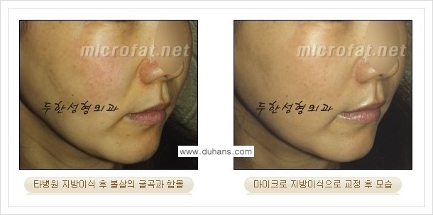[두한성형외과 경쟁력 볼살지방이식] - [타병원 지방이식 후 - 굴곡이 발생한 경우, 과주입으로 인해 볼살이 불룩한 경우 안내] 관련 이미지 2