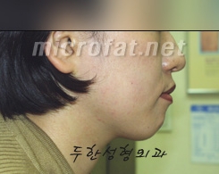 [두한성형외과 보톡스] - [사각턱 보톡스 시술 안내] 관련 이미지 11