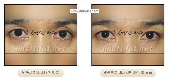 [두한성형외과 경쟁력 미세 #지방이식 ] - [윗 #눈꺼풀함몰, #꺼진눈꺼풀, #눈위지방이식, #눈위함몰] 관련 이미지 16