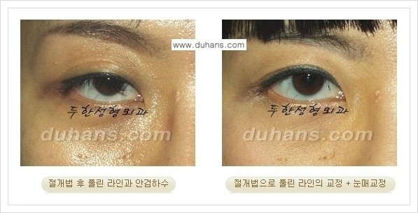 [두한성형외과 경쟁력 쌍꺼풀 재수술, 극한 재수술] - [풀려버린 쌍꺼풀 라인의 교정 방법 안내] 관련 이미지 6