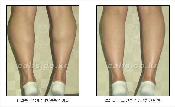 [두한성형외과 경쟁력 종아리성형] - [초음파 유도 선택적 신경차단술 안내 ④] 관련 이미지 2