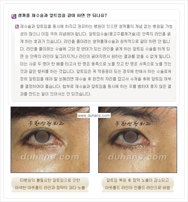 ​​[두한성형외과 경쟁력 쌍꺼풀(눈) 재수술] - [쌍꺼풀(눈) 재수술 Q&A 모음] 관련 이미지 3