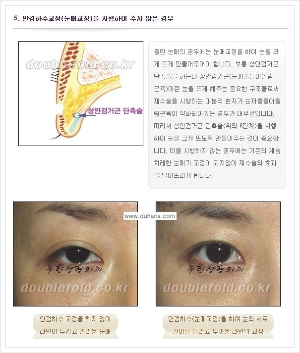 [두한성형외과 경쟁력 쌍꺼풀 재수술, 극한 재수술] - [쌍꺼풀 재수술 실패 원인(Cause of reoperation fail) 안내] 관련 이미지 5