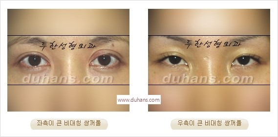 [두한성형외과 경쟁력 눈성형] - [나에게 맞는 어울리는 쌍꺼풀 라인] 관련 이미지 28