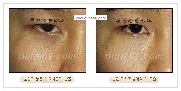[두한성형외과 경쟁력 눈밑성형] - [다크써클과 눈밑주름을 위한 미세지방이식 안내] 관련 이미지 2