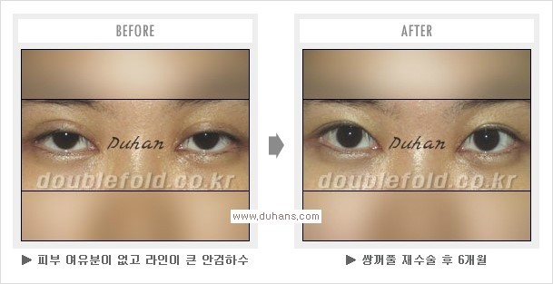 [두한성형외과 경쟁력 쌍꺼풀 재수술, 극한 눈재수술] - [망친 쌍꺼풀, 망가진 쌍꺼풀 복원수술, 재수술의 성공요건] 관련 이미지 5