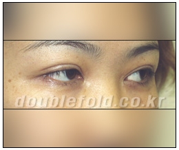 [Duhan Plastic Surgery Reoperation for Double Eyelids] - [Lowering the Double Eyelid Line] image 2