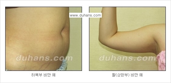 [두한성형외과 경쟁력 간편지방흡입] - [복부(뱃살) 비만 간편지방흡입] 관련 이미지 3