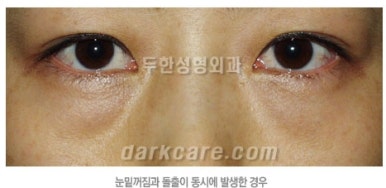 ​[두한성형외과 동안성형] - ​[하안검수술, 상안검수술, 눈썹거상술] 관련 이미지 73