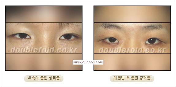 [두한성형외과 경쟁력 쌍꺼풀 재수술, 극한 눈재수술] - [풀린 쌍꺼풀 라인 교정수술 안내] 관련 이미지 1