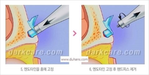 [두한성형외과 경쟁력 Quick 주름성형] - [주름제거, 탄력증대! 리프팅 시리즈 안내] 관련 이미지 29