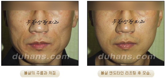[Duhan Plastic Surgery Wrinkle Removal] - [Wrinkle Removal Treatment Methods] image 30