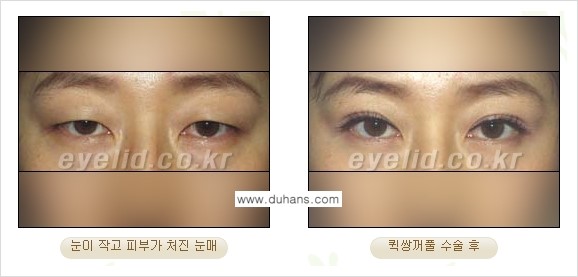 [두한성형외과 성형 FOCUS] - [퀵쌍꺼풀 수술 ②] 관련 이미지 4