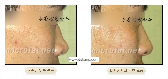 [두한성형외과 경쟁력 코성형] - [미세지방이식을 이용한 자연스러운 코성형 안내] 관련 이미지 12