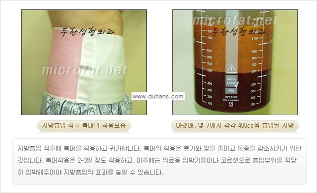 [두한성형외과 겨울엔 지방흡입 도전] - [간편한 복부지방흡입 1.] 관련 이미지 11