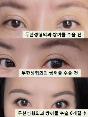 [두한성형외과 눈재수술] - [#쌍꺼풀재수술 #재수술 후기 #쌍꺼풀 라인낮추기] 관련 이미지 2
