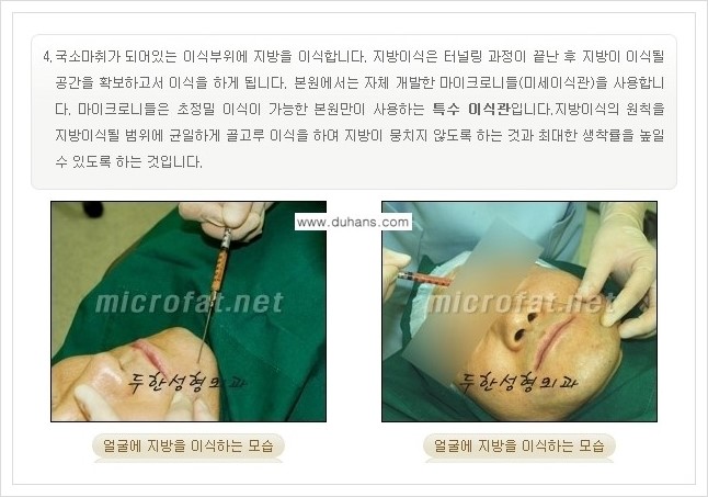 ⁠⁠[두한성형외과 경쟁력 볼살지방이식] - [심하게 야윈 주름이 있는 얼굴, 역삼각형 협소한 얼굴, 광대뼈가 돌출되어 보이는 경우 안내] 관련 이미지 8