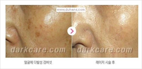 [두한성형외과 경쟁력 눈밑성형] - [다크써클 + 검버섯 레이저 콤비 프로그램 안내] 관련 이미지 11
