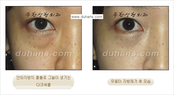 [두한성형외과 젊은 눈매 안검성형] - [눈밑 지방제거의 수술 전후 안내 ①] 관련 이미지 12