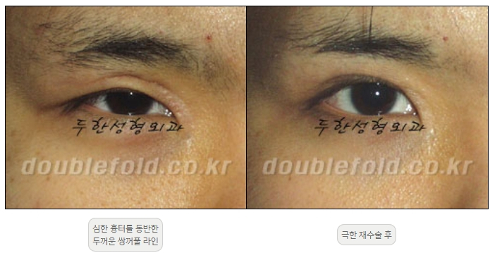 [Duhan Plastic Surgery Double Eyelid Revision] - [Thick Double Eyelid Line] image 47