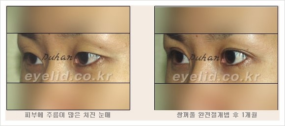 [두한성형외과 경쟁력 눈성형] - [눈성형 방법에 대한 흔한 질문과 답변 안내] 관련 이미지 7