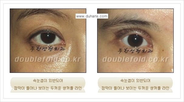 [두한성형외과 경쟁력 쌍꺼풀 재수술, 극한 재수술] - [속눈썹 외반 수술 방법 안내] 관련 이미지 2