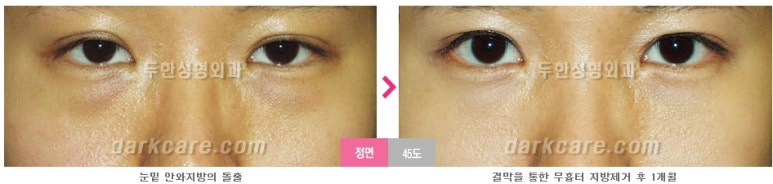 [두한성형외과 다크서클] - [다크서클 전후사진 검증] 관련 이미지 104