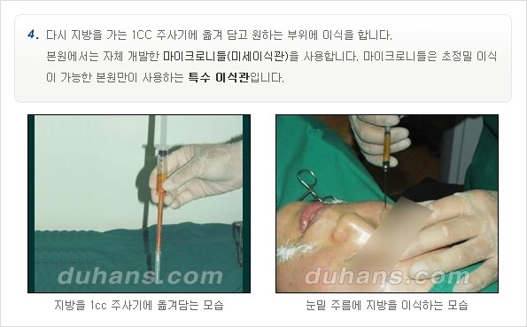 [두한성형외과 경쟁력 주름성형] - [미세지방이식을 이용한 주름교정 안내 - 이마주름, 미간주름 1.] 관련 이미지 9