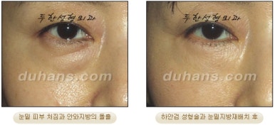 Blepharoplasty, Duhan Plastic Surgery - Upper and Lower Eyelids image 25