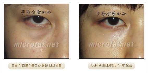 ​[두한성형외과 경쟁력 눈밑성형 리더] - [눈밑 다크써클의 증상, 원인, 종류, 치료방법 안내] 관련 이미지 24
