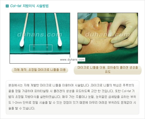 [두한성형외과 경쟁력 미세지방이식] - [탄력있는 피부와 윤곽을 만들어주는 Col-fat 지방이식] 관련 이미지 5
