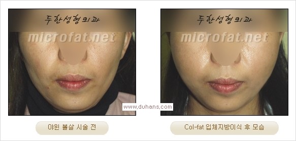 [두한성형외과 경쟁력 지방이식] - [두한 자가지방이식 클리닉 안내]​ 관련 이미지 44