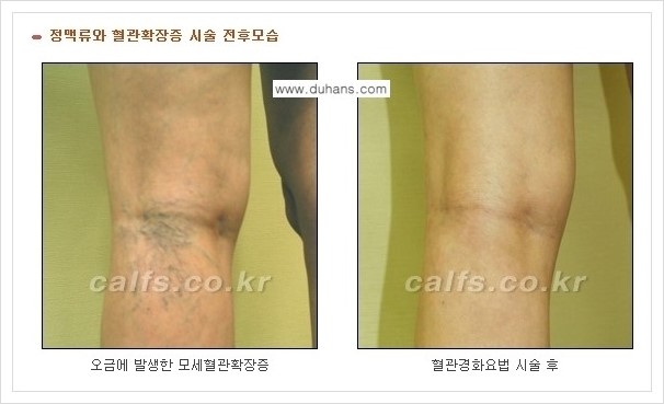 [두한성형외과 경쟁력 멀티종아리성형] - [나에게 맞는 종아리 시술 방법과 종류 안내 ③] 관련 이미지 13