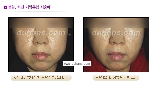 ​​​﻿[두한성형외과 경쟁력 간편지방흡입] - [볼살지방흡입, 턱선지방흡입 시술 과정의 안내] 관련 이미지 7