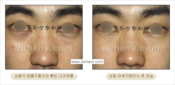 [두한성형외과 경쟁력 미세지방이식] - [다크써클 & 눈밑주름 미세지방이식 3.] 관련 이미지 9