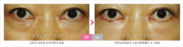 ​[두한성형외과 경쟁력 눈밑성형 리더] - [눈밑 다크써클의 증상, 원인, 종류, 치료방법 안내] 관련 이미지 70