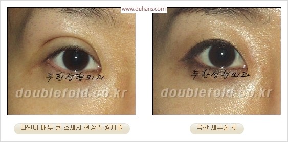 [두한성형외과 경쟁력 눈성형] - [극한 재수술, 함몰된 눈꺼풀 라인교정, 안검하수(졸리운 눈매)] 관련 이미지 21